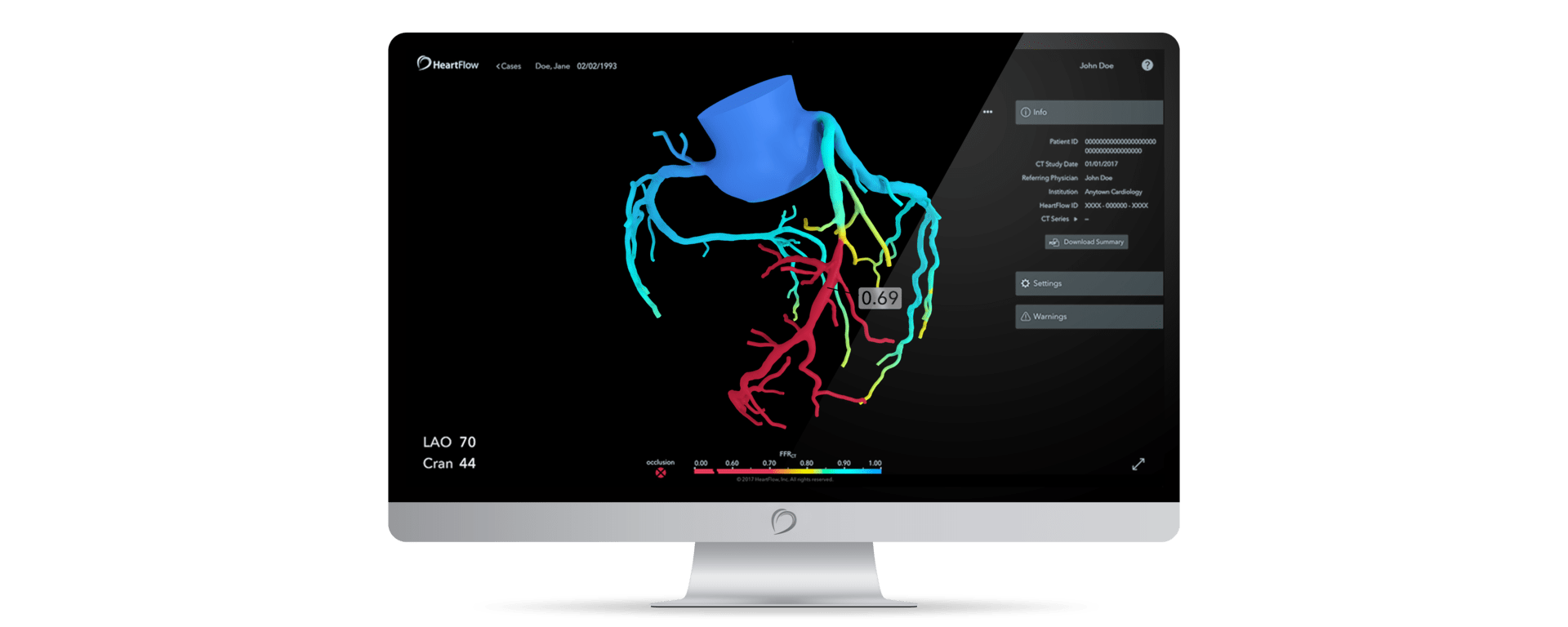 HeartFlow Customer Service Story